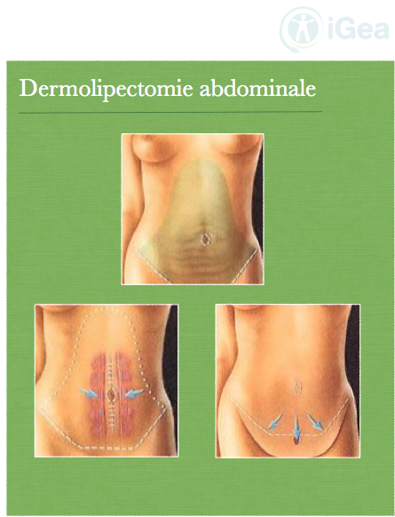 Abdominoplastie Montpellier
