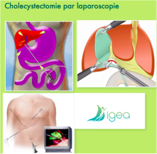 ablation vésicule dr Salsano Montpellier