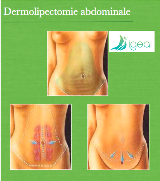 Dermolipectomie avec répositionnement de l'ombilic et fermeture diastasis dr SALSANO Montpellier Salerno