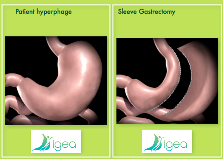 Sleeve Gastrectomie diminution volume gastrique