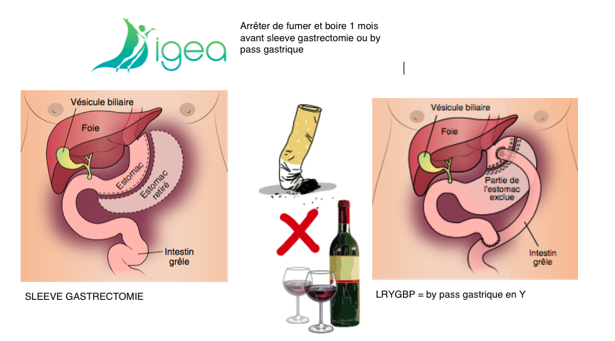 STOP TABAGISME ET ALCOOL AVANT SLEEVE OU BY PASS GASTRIQUE
