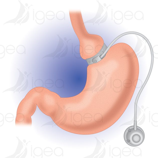 Print anneau gastrique gastric banding bendaggio gastrico