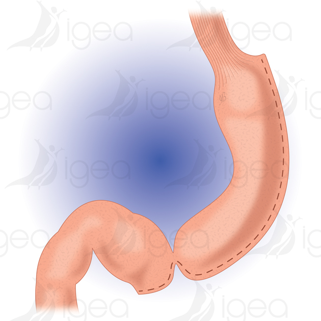 Print anneau gastrique gastric banding bendaggio gastrico