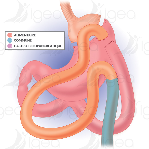 By Pass gastrique en Y By Pass gastrique en Y