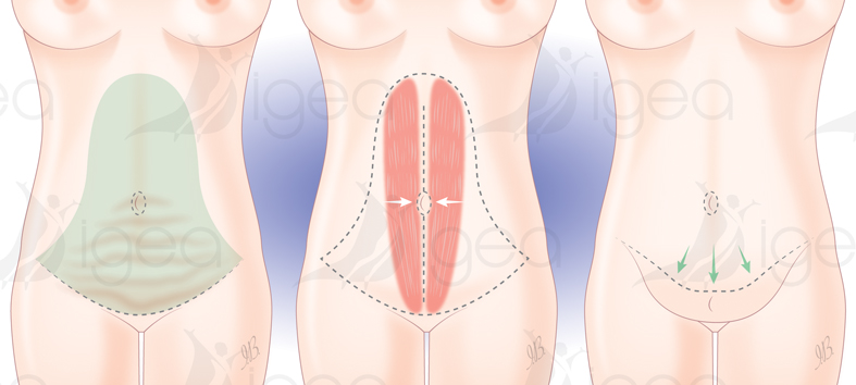Print anneau gastrique gastric banding bendaggio gastrico