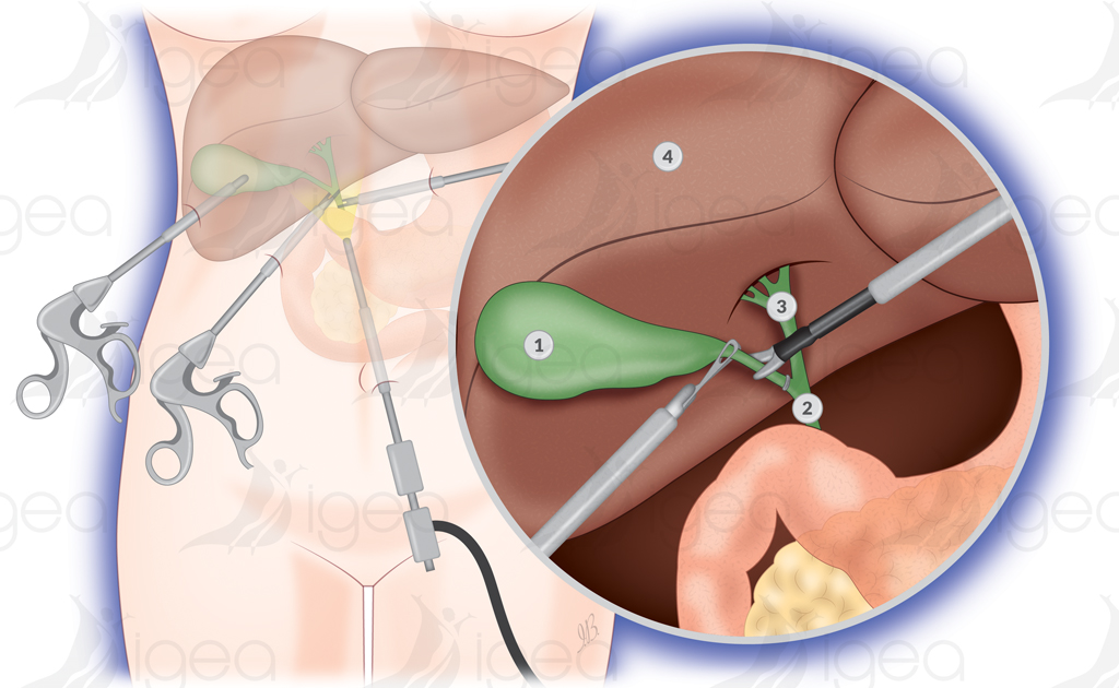 vésicule biliaire ablation vesicule biliaire ablation