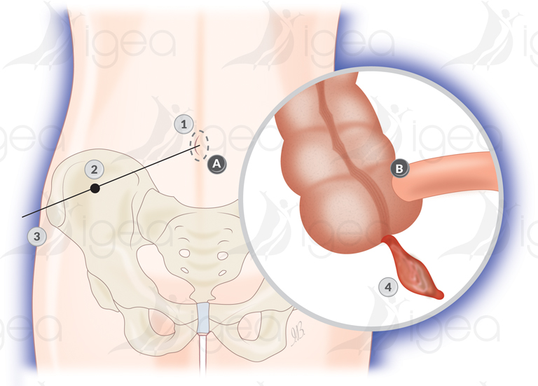 apendicsectomie