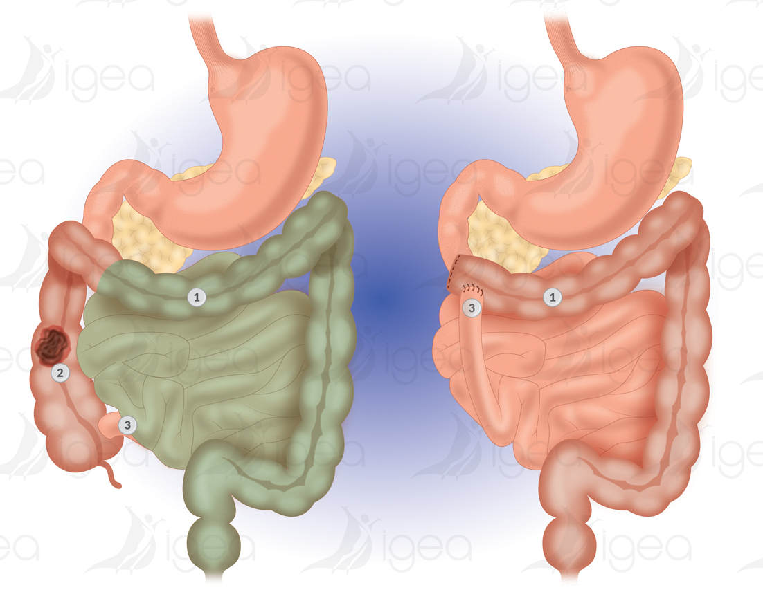 colon droit colon droit