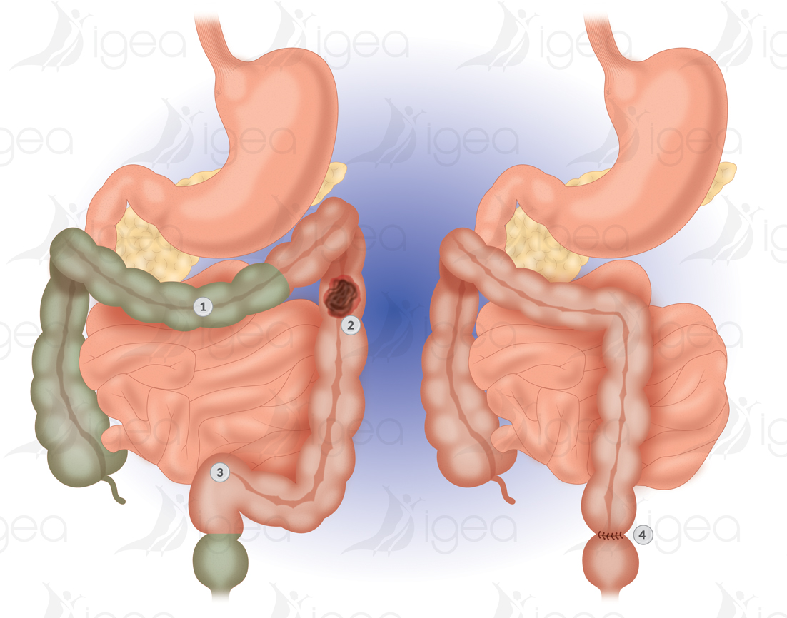 Colon gauche Colon gauche