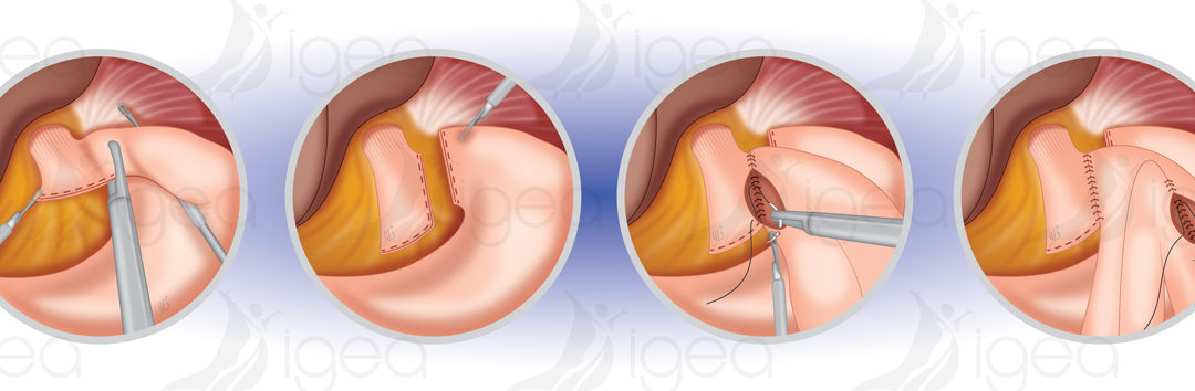 Comprendre le ByPass gastrique en Y