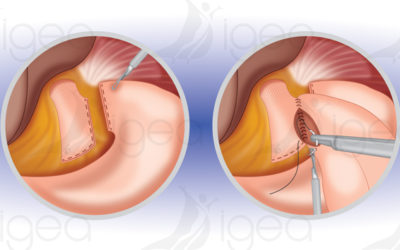 Comprendre le ByPass gastrique en Y