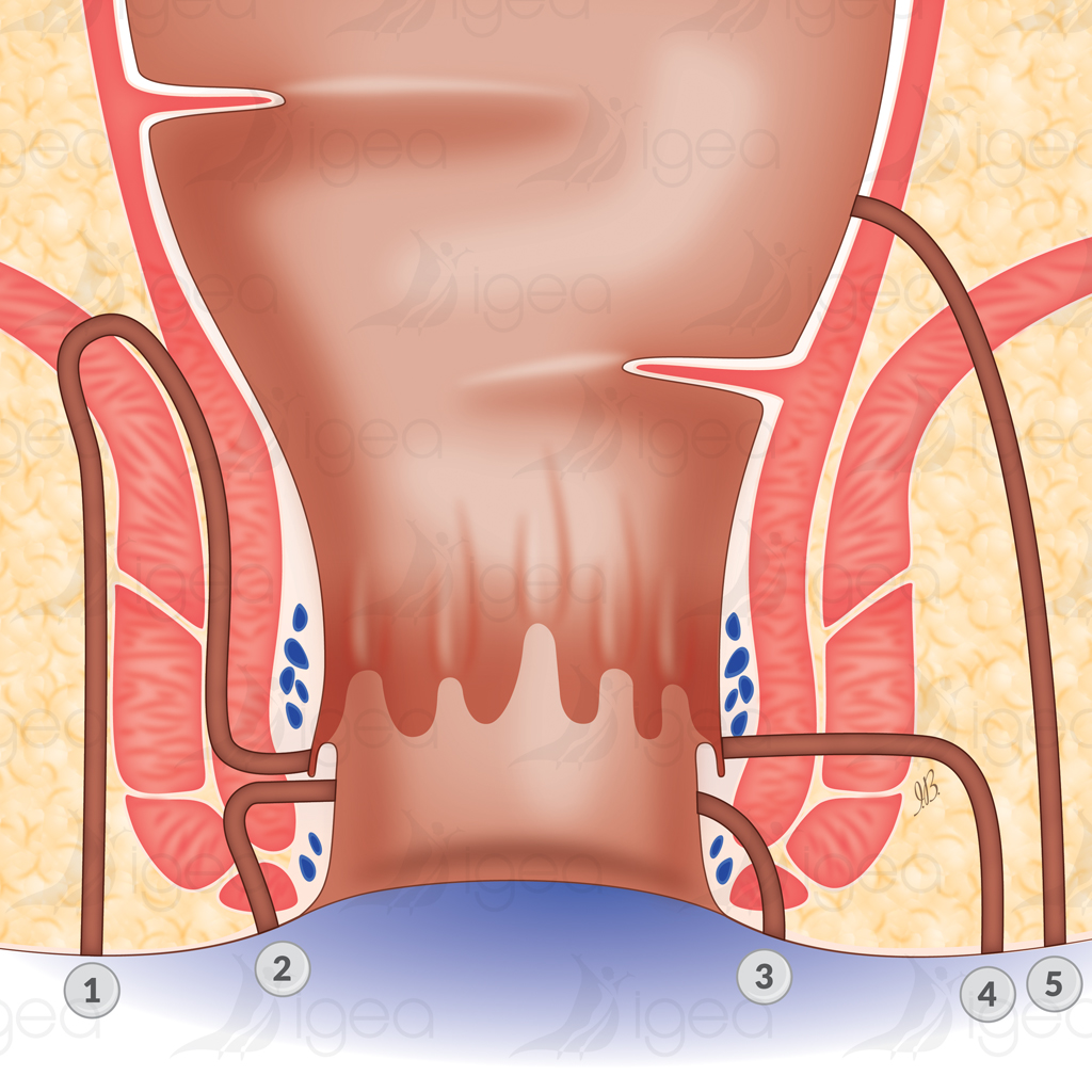 fistule anale fistule anale
