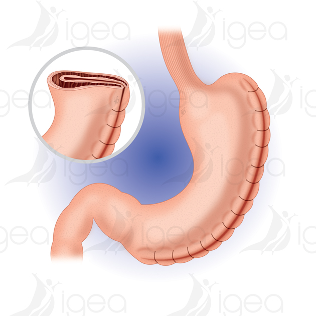 15_Plicatura gastrica anneau gastrique gastric banding bendaggio gastrico