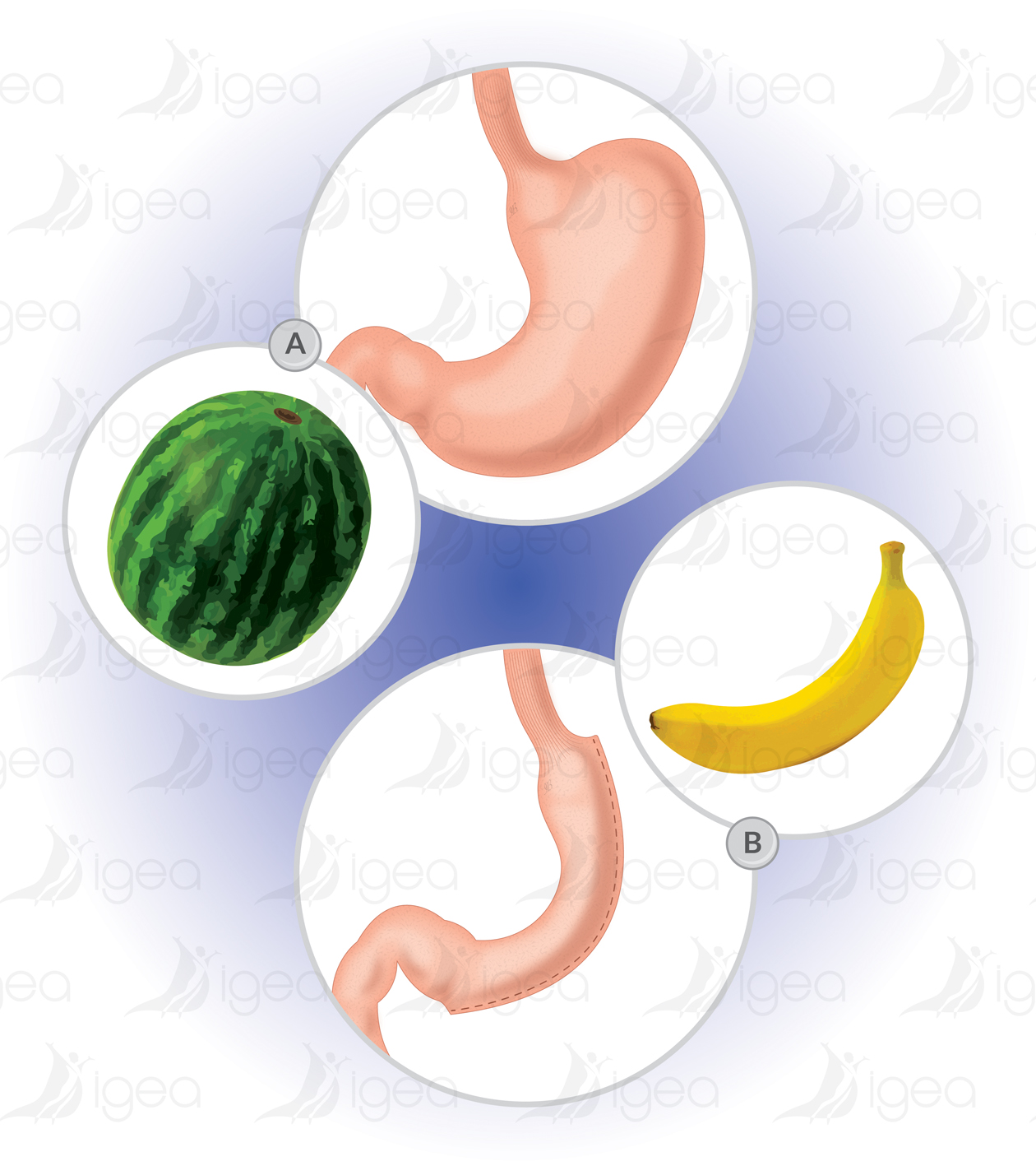 d anneau gastrique gastric banding bendaggio gastrico